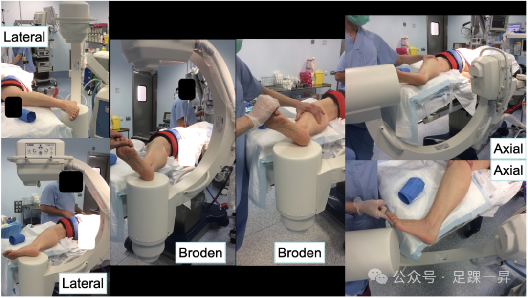 手术技巧｜经跗骨窦入路治疗跟骨骨折的西班牙经验