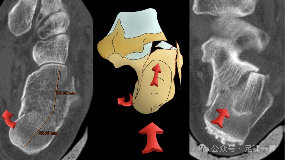 手术技巧｜经跗骨窦入路治疗跟骨骨折的西班牙经验