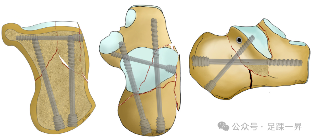 手术技巧｜经跗骨窦入路治疗跟骨骨折的西班牙经验
