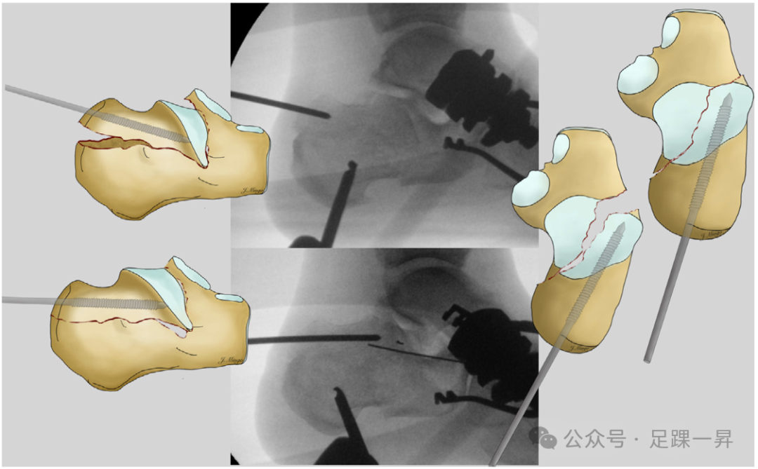 手术技巧｜经跗骨窦入路治疗跟骨骨折的西班牙经验