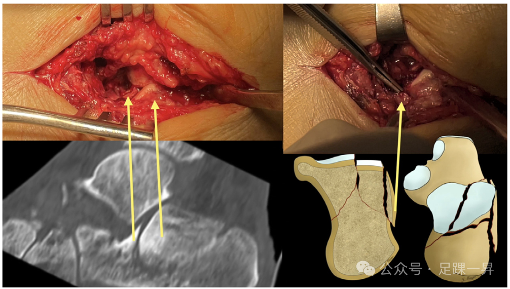 手术技巧｜经跗骨窦入路治疗跟骨骨折的西班牙经验