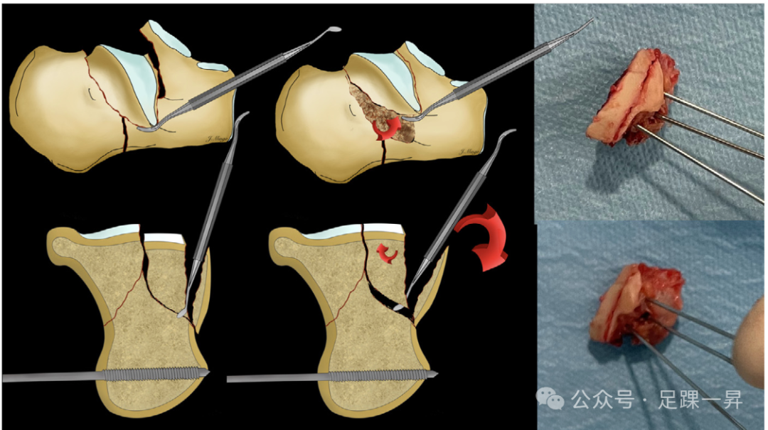 手术技巧｜经跗骨窦入路治疗跟骨骨折的西班牙经验