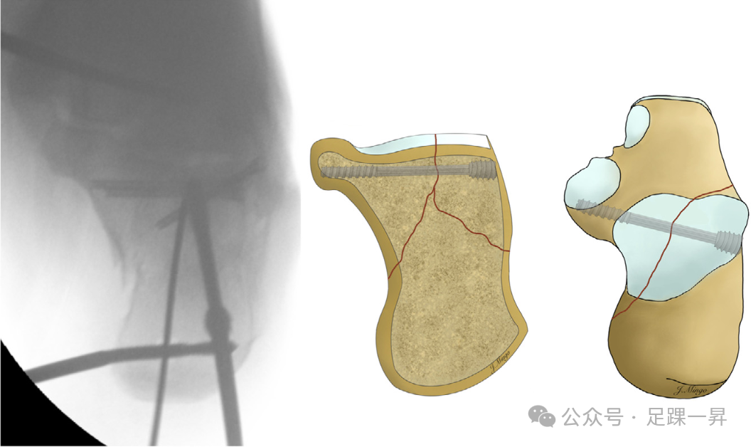 手术技巧｜经跗骨窦入路治疗跟骨骨折的西班牙经验