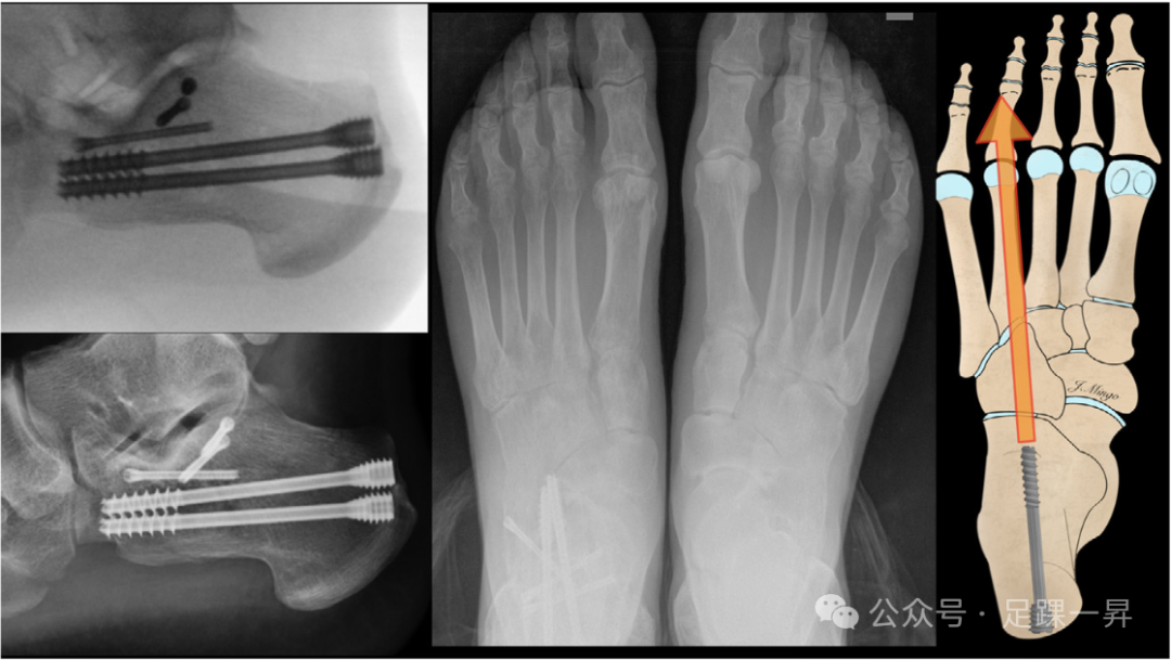 手术技巧｜经跗骨窦入路治疗跟骨骨折的西班牙经验