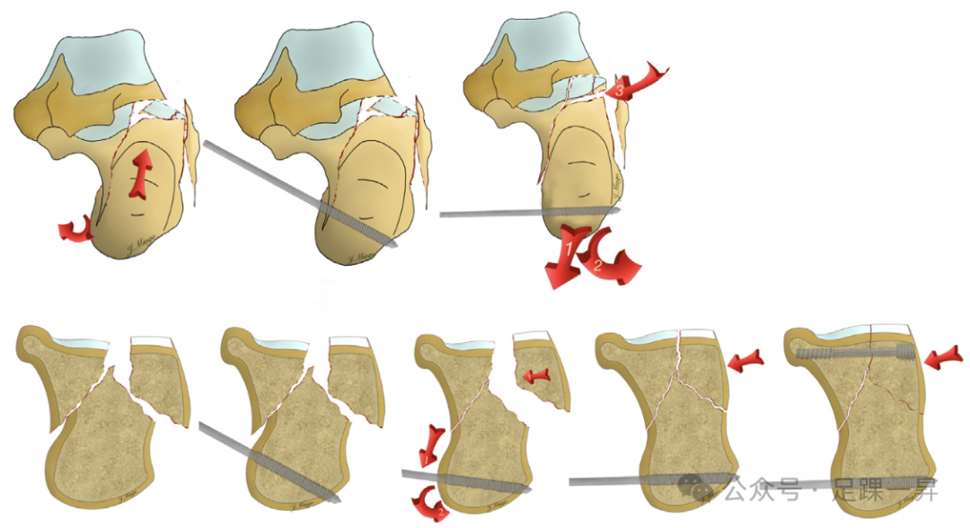 手术技巧｜经跗骨窦入路治疗跟骨骨折的西班牙经验