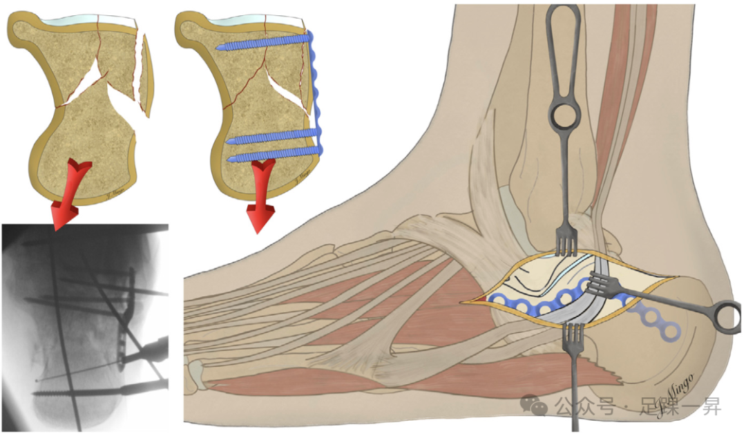 手术技巧｜经跗骨窦入路治疗跟骨骨折的西班牙经验