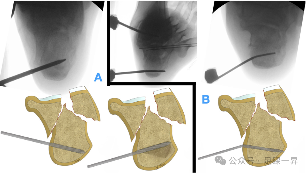 手术技巧｜经跗骨窦入路治疗跟骨骨折的西班牙经验