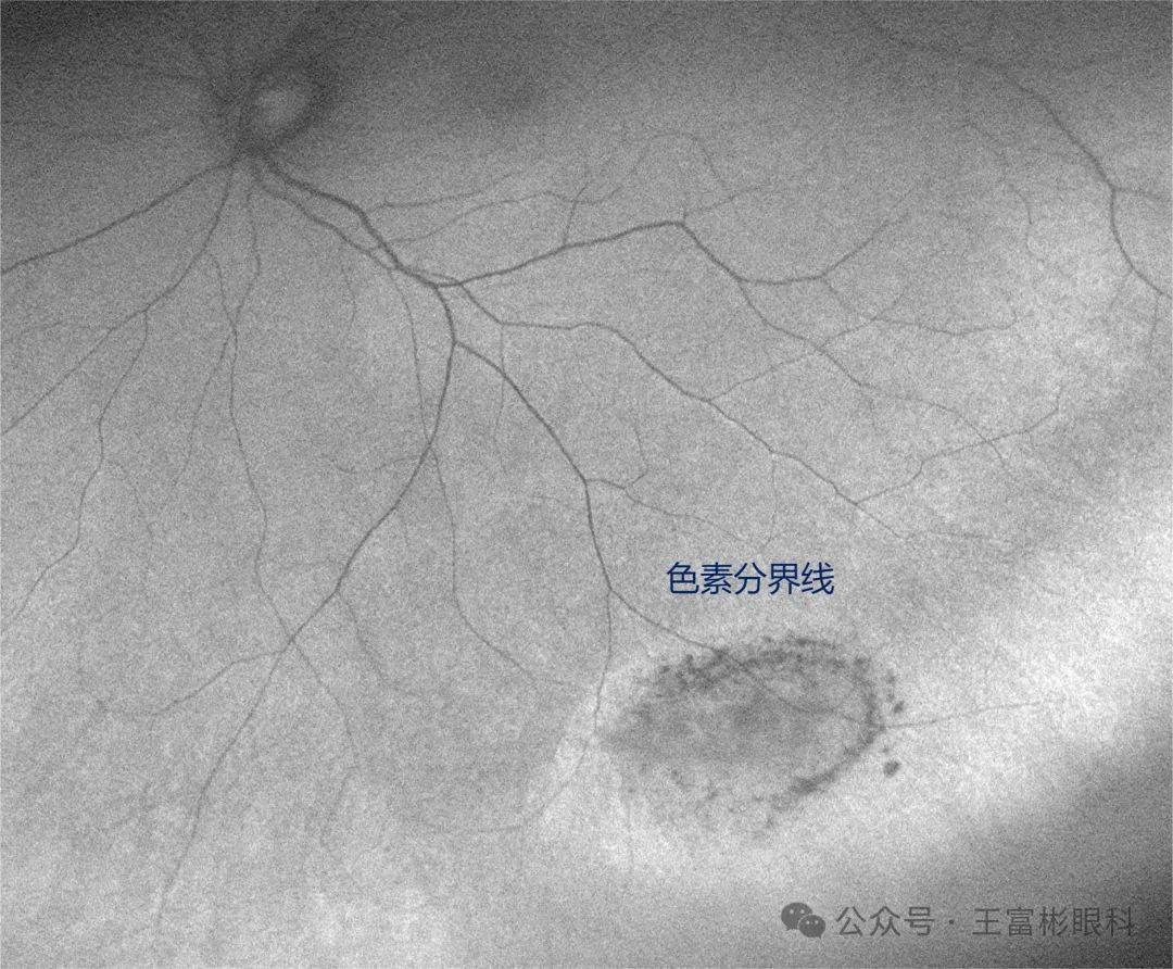 后天性视网膜劈裂症：临床层面的甄别