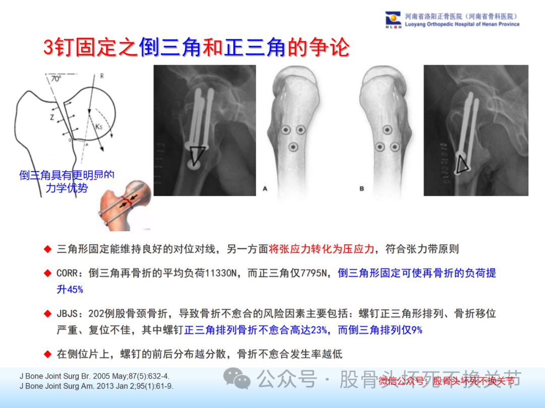 股骨颈骨折