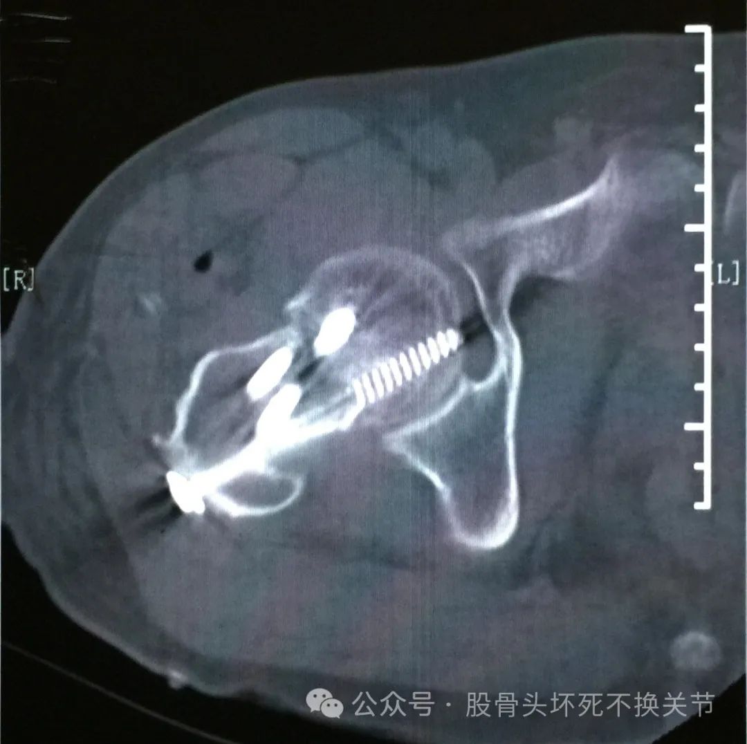 股骨颈骨折