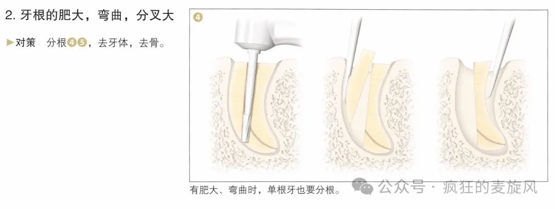 一个简单的残根，换了三个医生死活拔不出来？