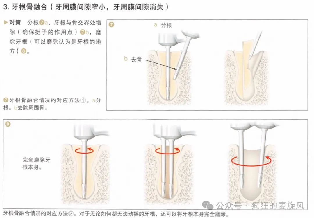 一个简单的残根，换了三个医生死活拔不出来？