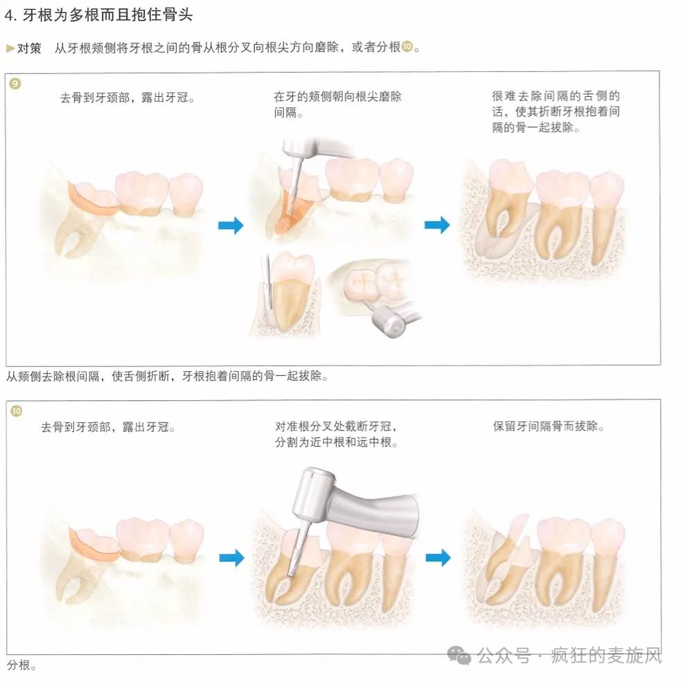 一个简单的残根，换了三个医生死活拔不出来？