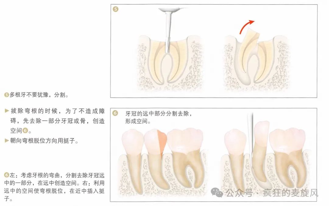 一个简单的残根，换了三个医生死活拔不出来？