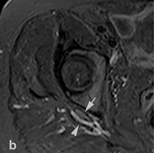 深部臀肌综合征：臀下间隙坐骨神经卡压的解剖、成像和处理