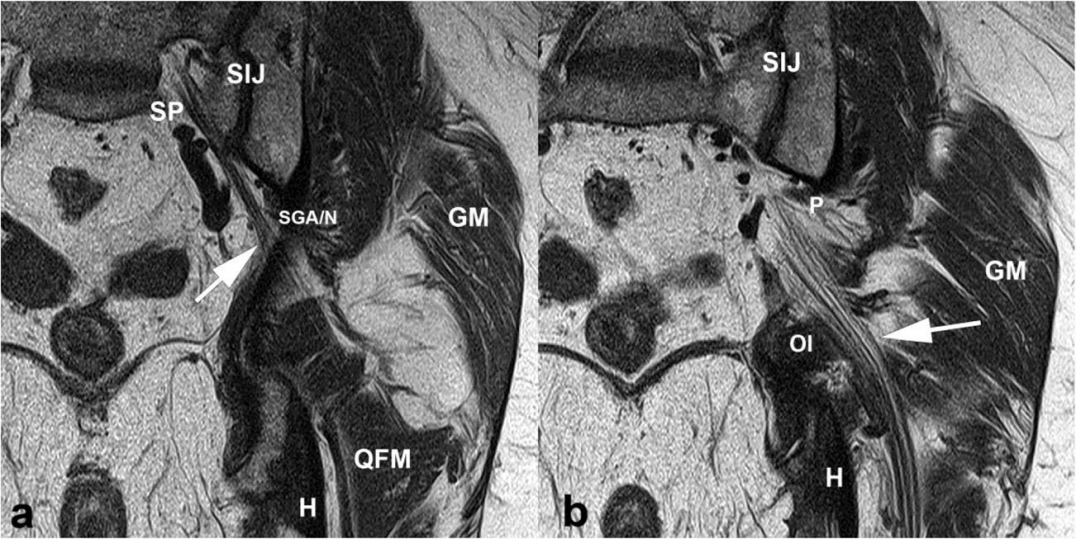 深部臀肌综合征：臀下间隙坐骨神经卡压的解剖、成像和处理