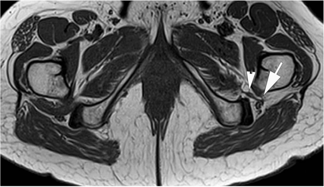 深部臀肌综合征：臀下间隙坐骨神经卡压的解剖、成像和处理
