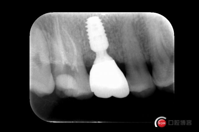 一例后牙即刻种植修复与瓷嵌体修复分享