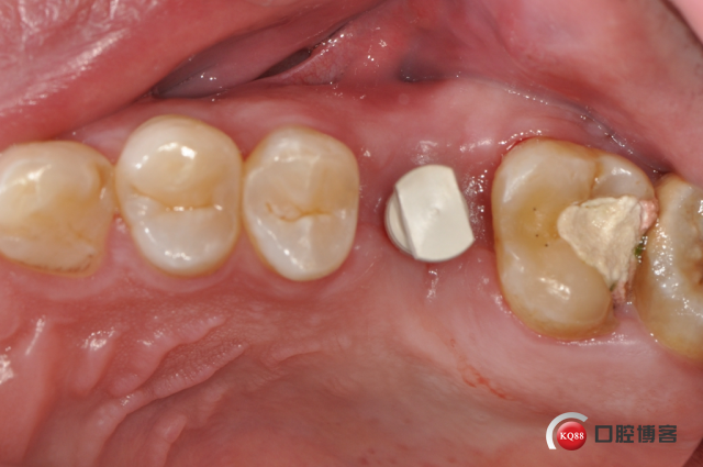 一例后牙即刻种植修复与瓷嵌体修复分享