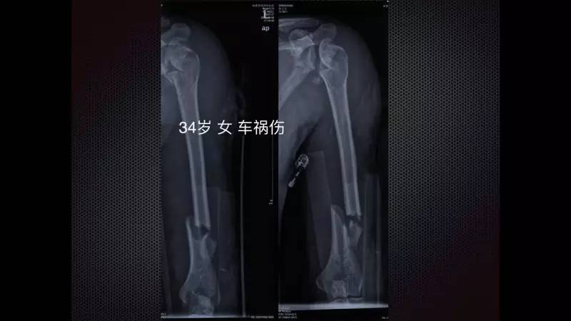 付中国教授带你病例探讨『肱骨近端骨折风险和治疗』