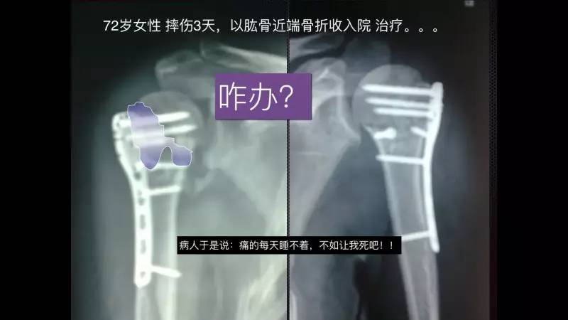 付中国教授带你病例探讨『肱骨近端骨折风险和治疗』
