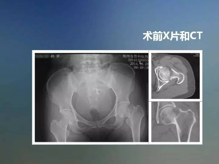 张长青教授：股骨颈骨折与切开复位固定技术