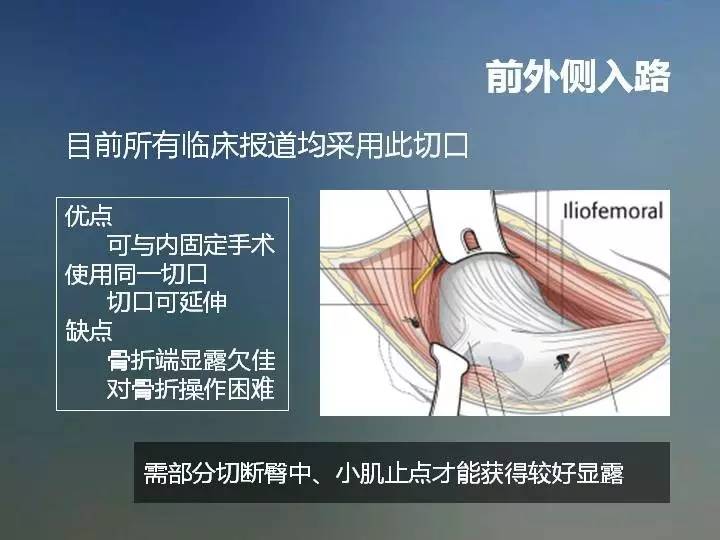 张长青教授：股骨颈骨折与切开复位固定技术