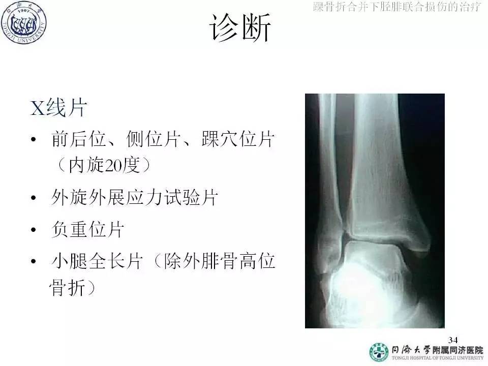 俞光荣教授带你了解踝骨折合并下胫腓联合损伤的治疗（上）