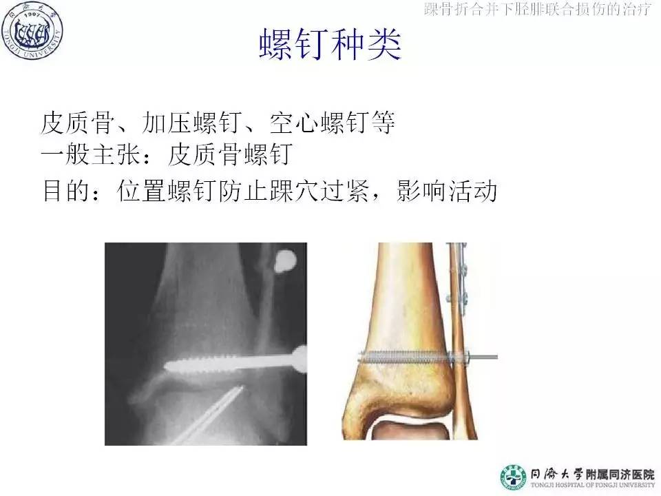 俞光荣：踝骨折合并下胫腓联合损伤的治疗（下）