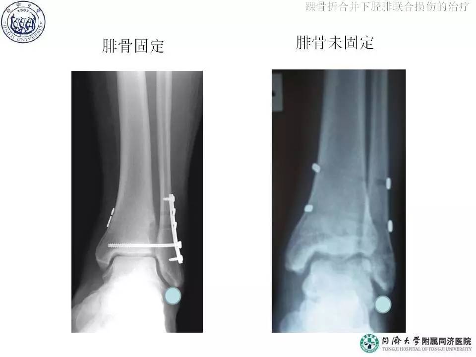 俞光荣：踝骨折合并下胫腓联合损伤的治疗（下）
