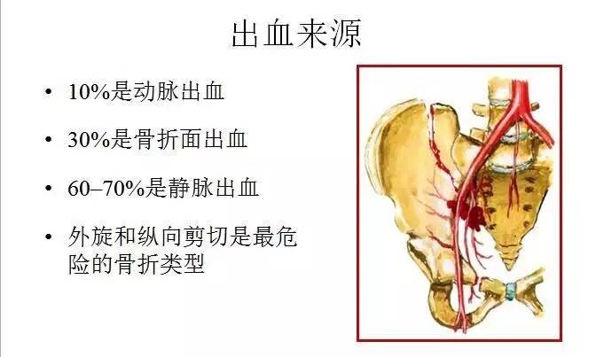 Hak博士-危及生命的骨盆骨折出血如何处理？