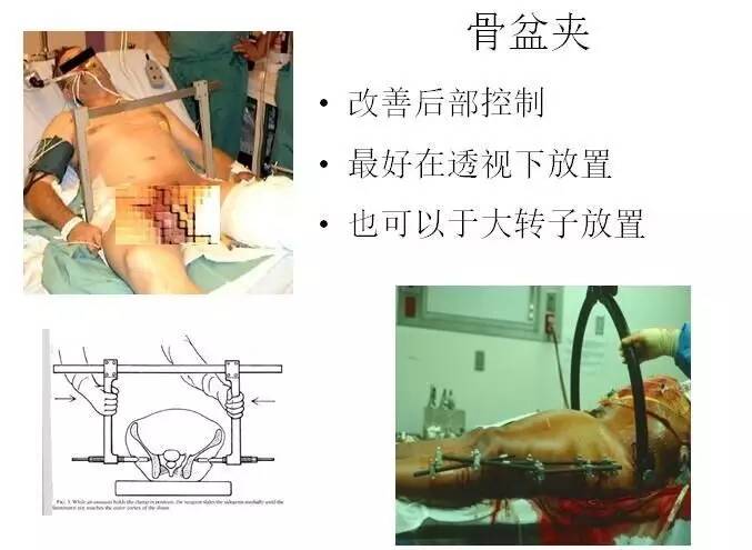 Hak博士-危及生命的骨盆骨折出血如何处理？