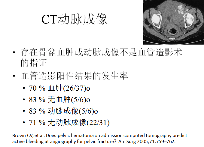 Hak博士-危及生命的骨盆骨折出血如何处理？