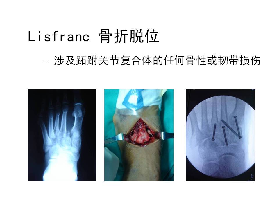 跖跗关节（Lisfranc）损伤的治疗技巧
