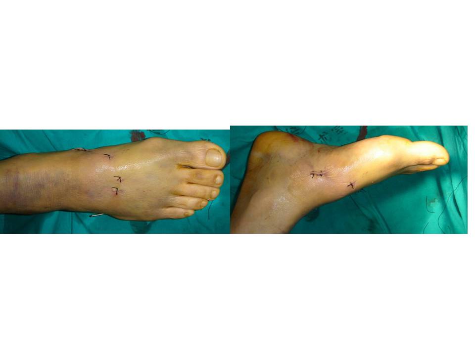 跖跗关节（Lisfranc）损伤的治疗技巧