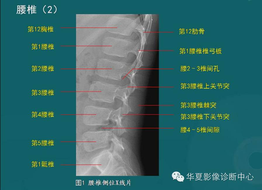 脊柱检查之X线、CT、MRI影像解剖