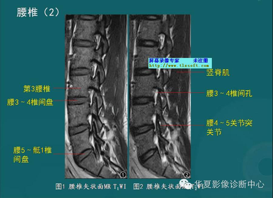 脊柱检查之X线、CT、MRI影像解剖