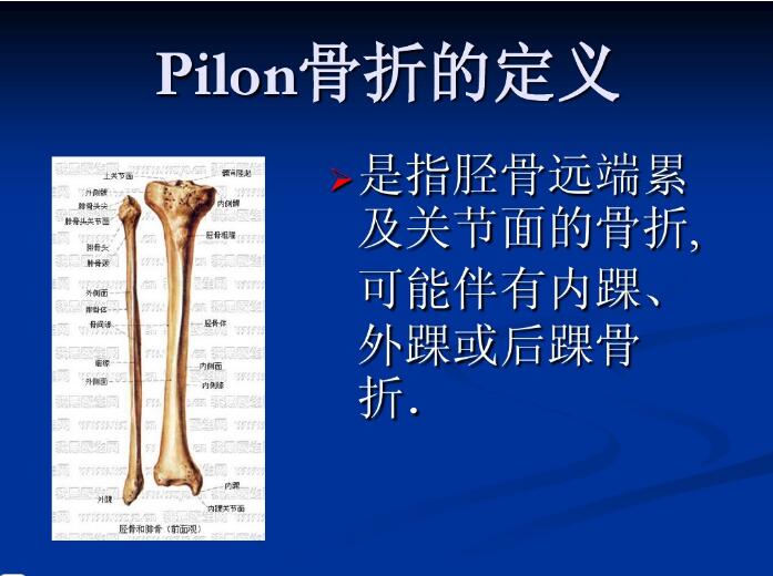 Pilon骨折的治疗策略与技巧