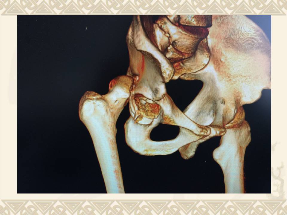 如何解决股骨头骨折合并髋关节脱位及髋臼后缘骨折