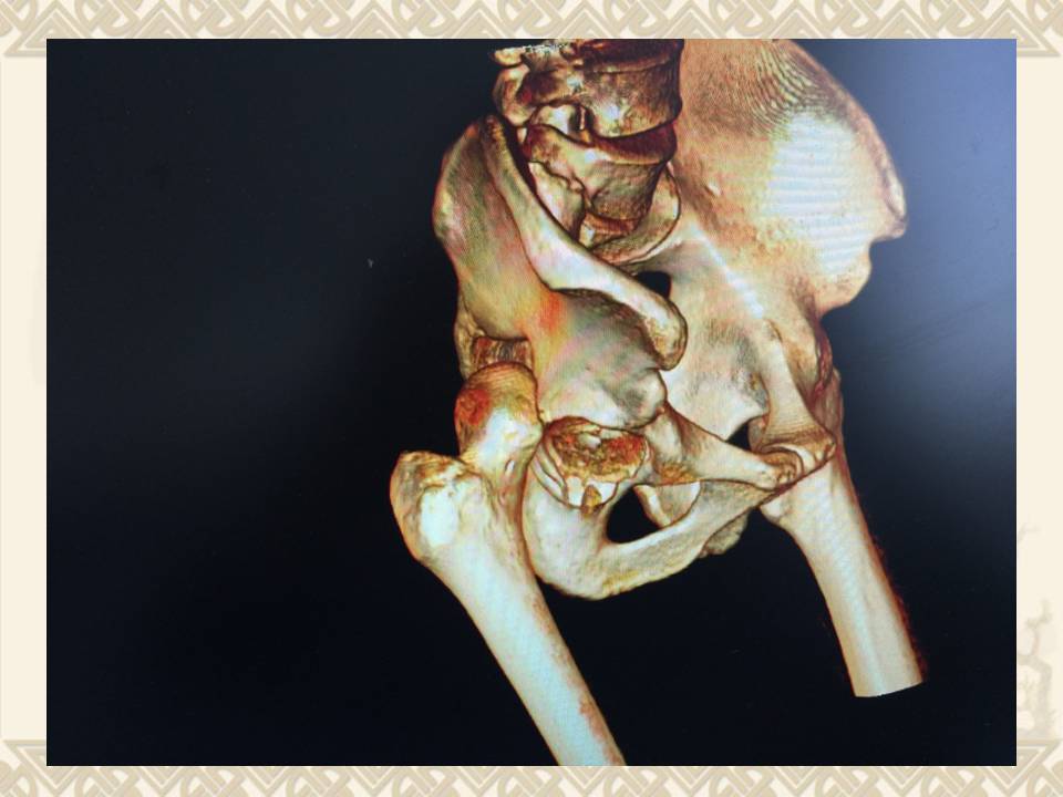 如何解决股骨头骨折合并髋关节脱位及髋臼后缘骨折