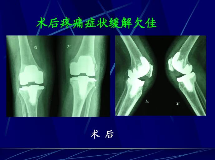 膝关节置换后常见问题分析