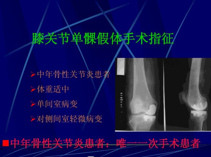 膝关节置换后常见问题分析