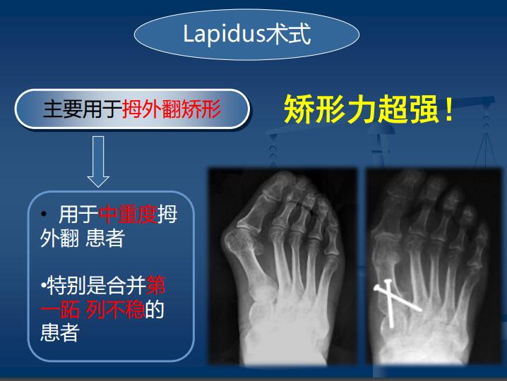 Lapidus手术难点