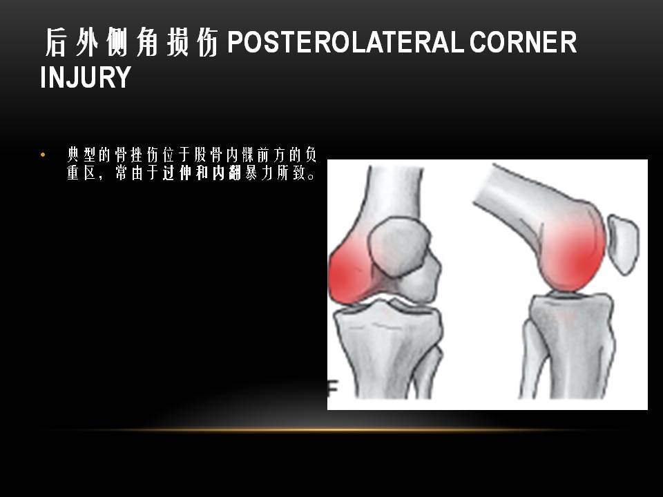 膝关节骨挫伤的分类及特点