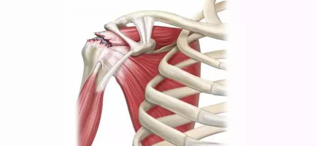 肩袖损伤—中老年肩关节疼痛的主要原因!