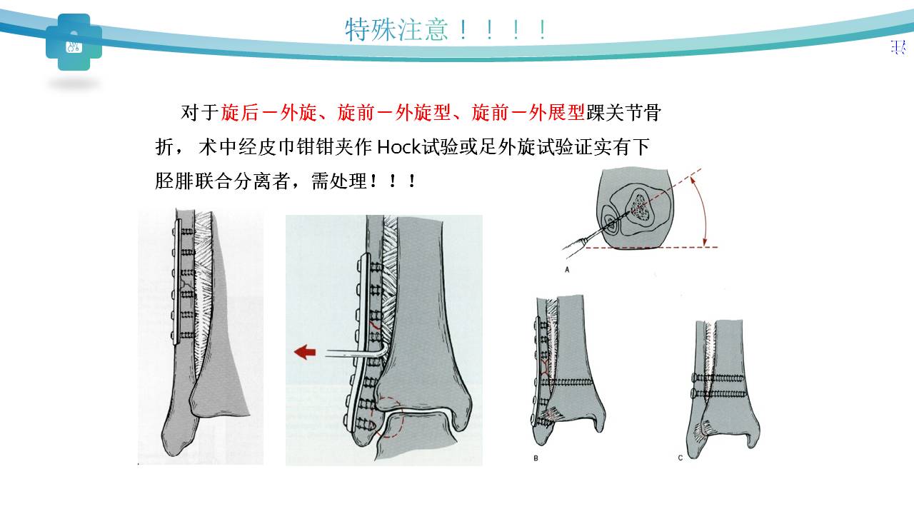 微创技术在踝关节骨折中的应用
