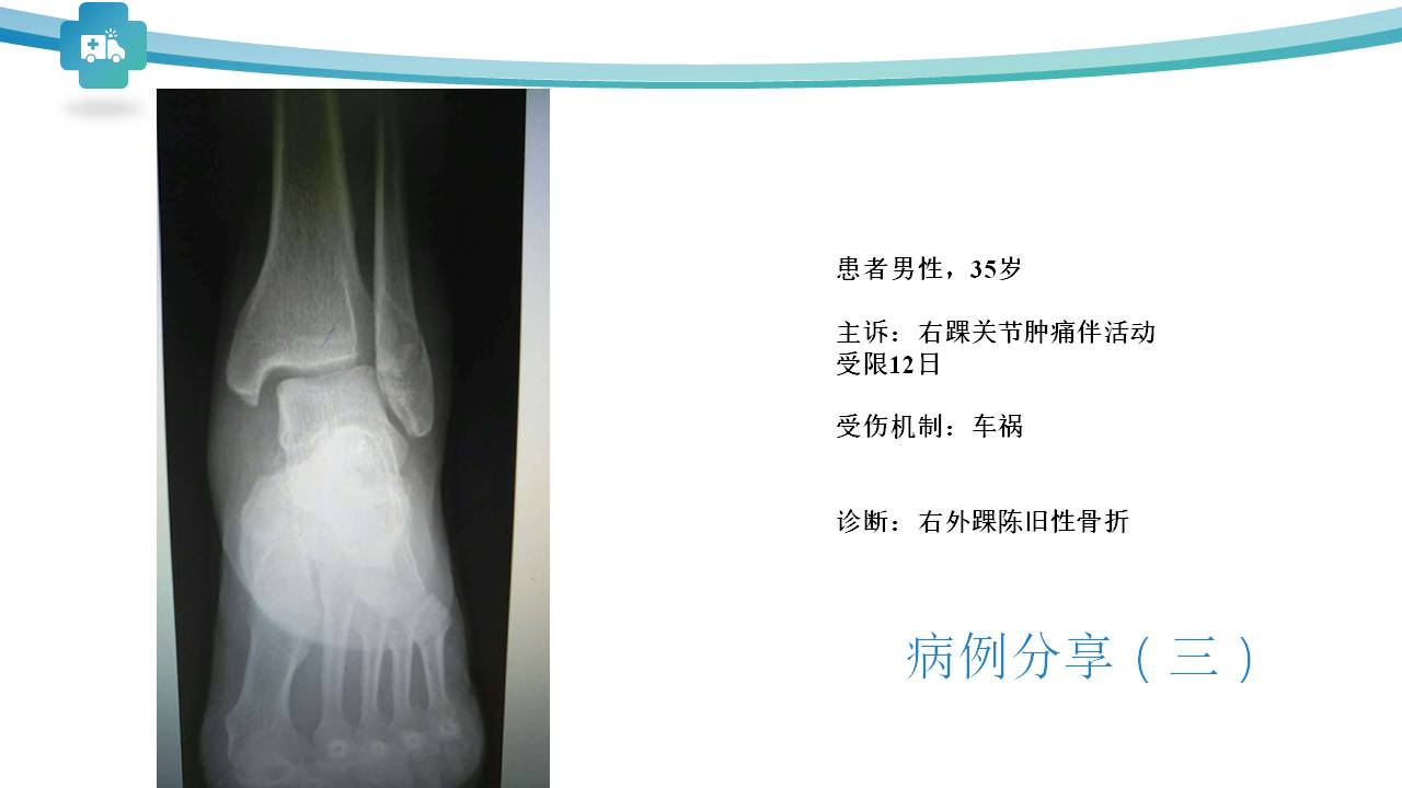 微创技术在踝关节骨折中的应用