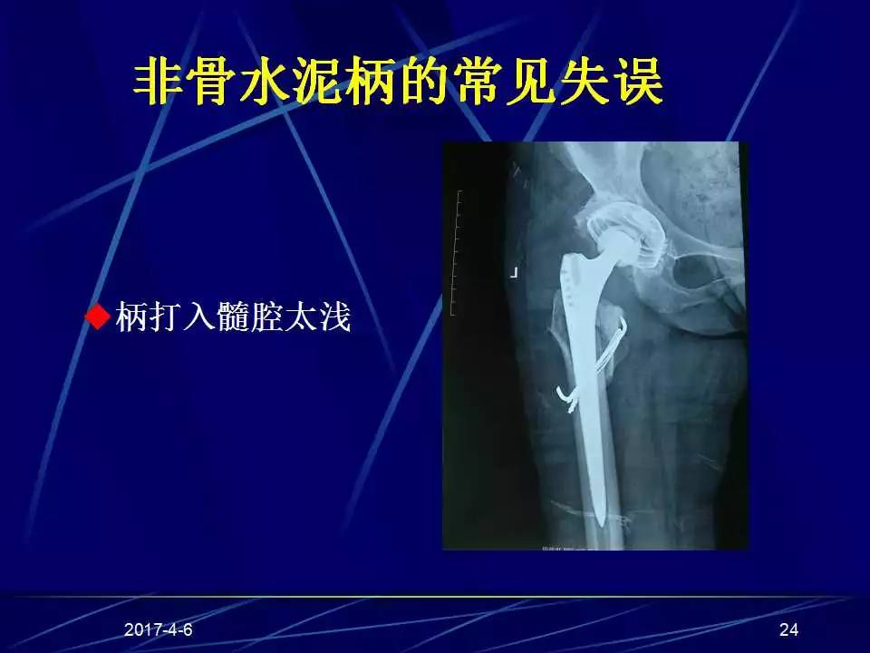 髋关节置换手术技巧及并发症的防范