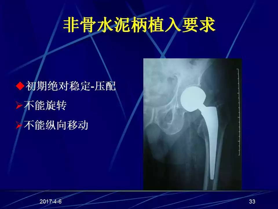 髋关节置换手术技巧及并发症的防范