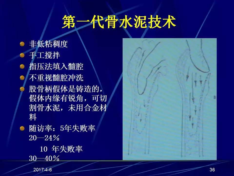 髋关节置换手术技巧及并发症的防范